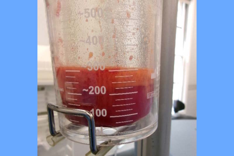 Gynecomastia Surgery Before & After Image