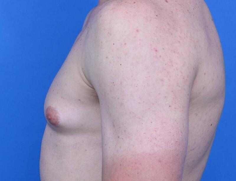 Gynecomastia Surgery Before & After Image
