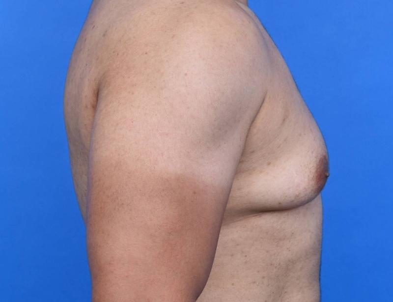 Gynecomastia Surgery Before & After Image