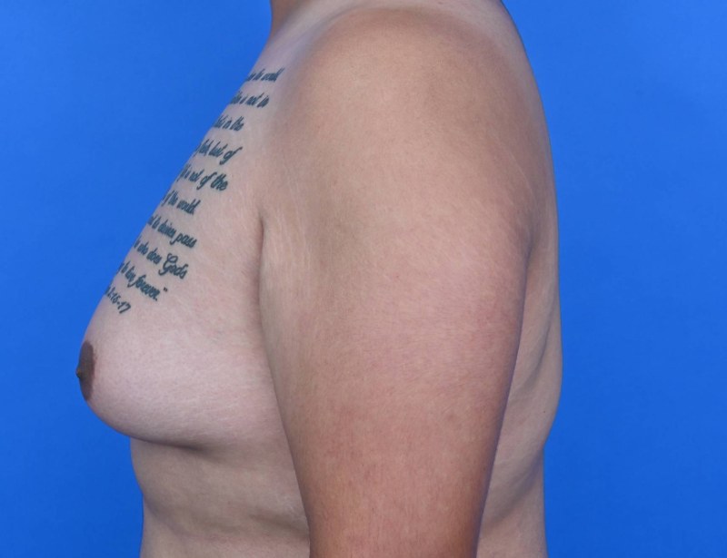 Gynecomastia Surgery Before & After Image