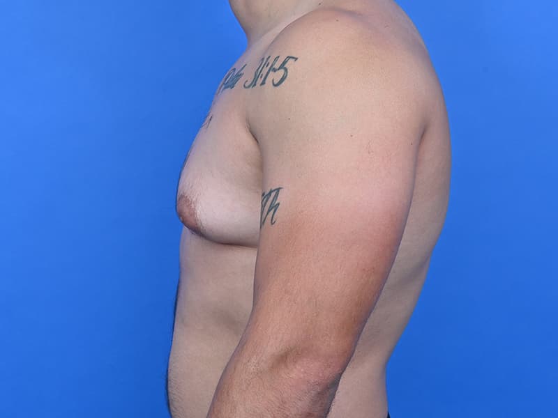 Gynecomastia Surgery Before & After Image