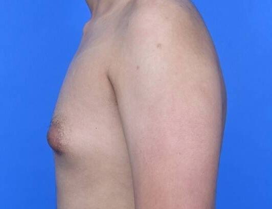 Gynecomastia Surgery Before & After Image