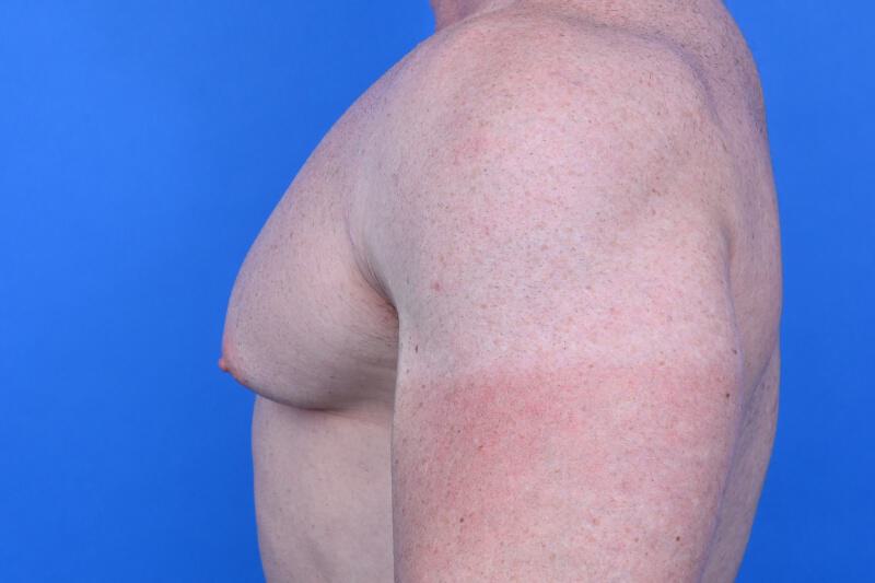 Gynecomastia Surgery Before & After Image