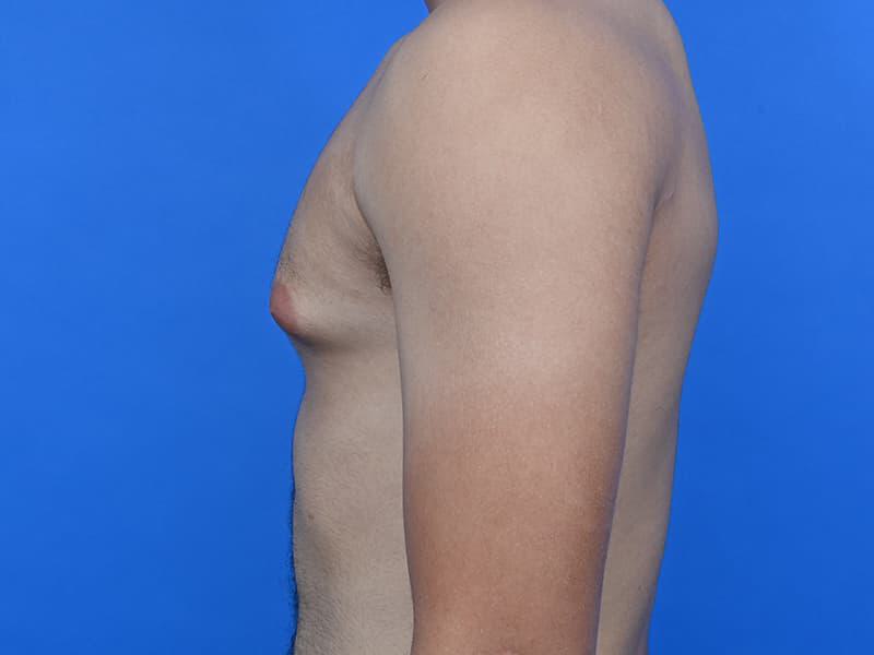 Gynecomastia Surgery Before & After Image