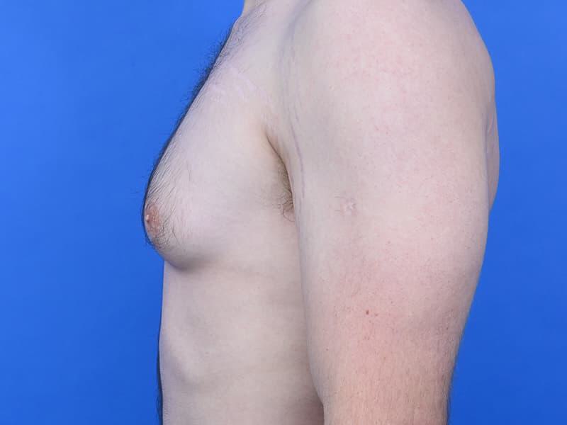 Gynecomastia Surgery Before & After Image