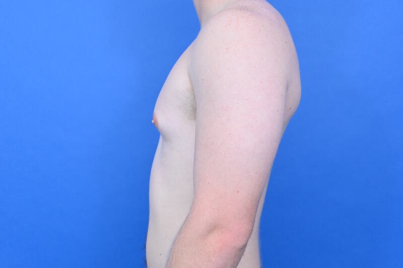 Gynecomastia Surgery Before & After Image