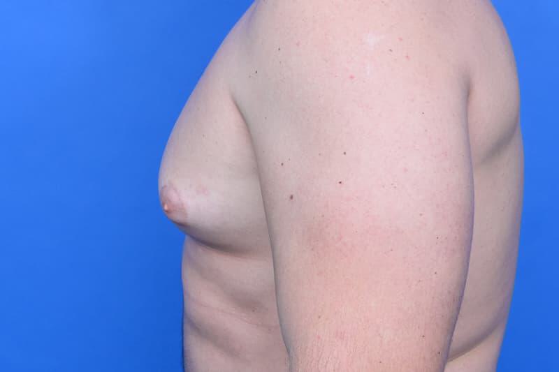 Gynecomastia Surgery Before & After Image