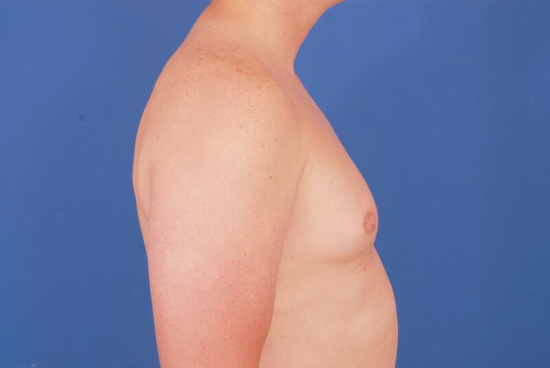 Gynecomastia Surgery Before & After Image