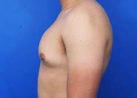 Gynecomastia Surgery Before & After Image