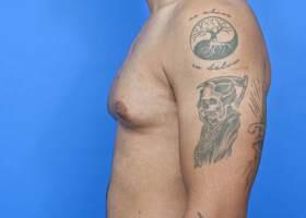 Gynecomastia Surgery Before & After Image