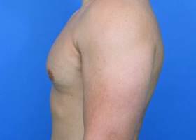 Gynecomastia Surgery Before & After Image