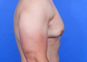 Gynecomastia Surgery Before & After Image