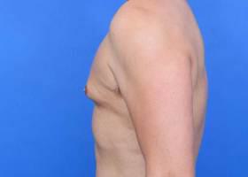 Gynecomastia Surgery Before & After Image