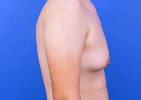 Gynecomastia Surgery Before & After Image