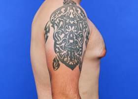 Gynecomastia Surgery Before & After Image