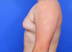 Gynecomastia Surgery Before & After Image