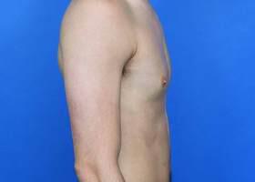 Gynecomastia Surgery Before & After Image