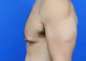 Gynecomastia Surgery Before & After Image