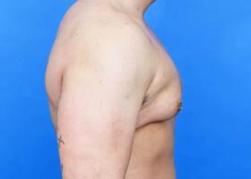 Gynecomastia Surgery Before & After Image
