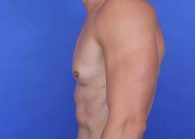 Gynecomastia Surgery Before & After Image