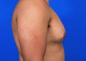 Gynecomastia Surgery Before & After Image