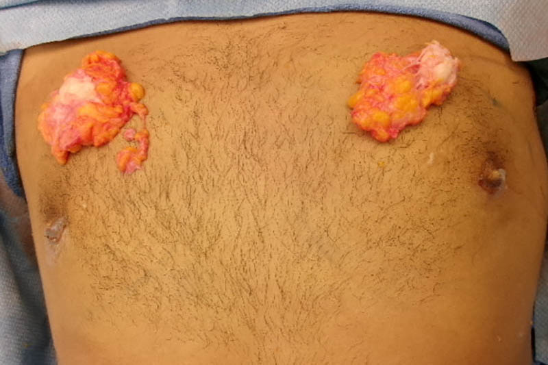 Gynecomastia Surgery Before & After Image