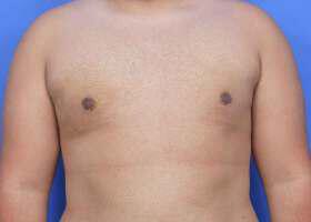 Gynecomastia Surgery Before & After Image