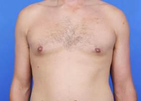 Gynecomastia Surgery Before & After Image