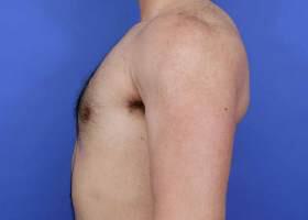 Gynecomastia Surgery Before & After Image