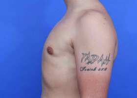 Gynecomastia Surgery Before & After Image