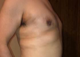 Gynecomastia Surgery Before & After Image