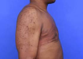 Gynecomastia Surgery Before & After Image