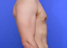 Gynecomastia Surgery Before & After Image
