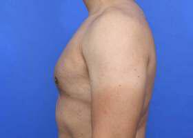 Gynecomastia Surgery Before & After Image