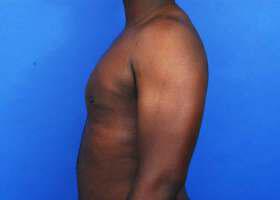 Gynecomastia Surgery Before & After Image