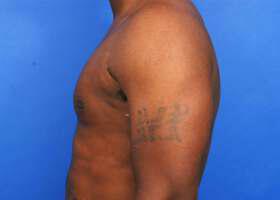 Gynecomastia Surgery Before & After Image