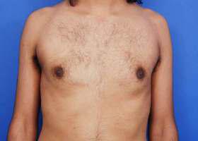 Gynecomastia Surgery Before & After Image