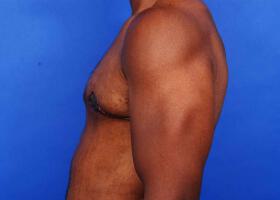 Gynecomastia Surgery Before & After Image