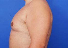 Gynecomastia Surgery Before & After Image