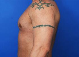 Gynecomastia Surgery Before & After Image
