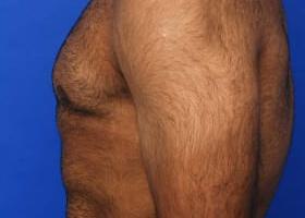 Gynecomastia Surgery Before & After Image