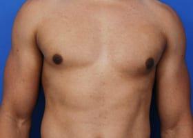 Gynecomastia Surgery Before & After Image