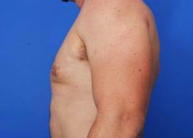 Gynecomastia Surgery Before & After Image