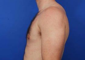 Gynecomastia Surgery Before & After Image
