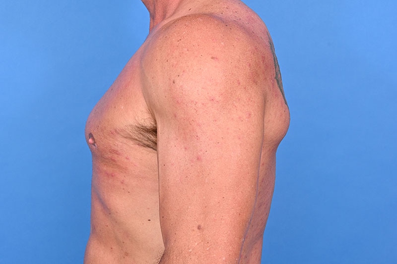 Gynecomastia Surgery Before & After Image