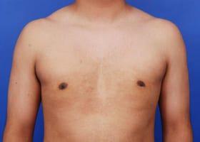 Gynecomastia Surgery Before & After Image