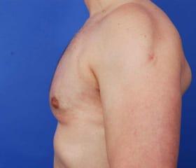 Gynecomastia Surgery Before & After Image