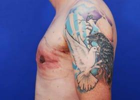 Gynecomastia Surgery Before & After Image