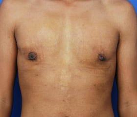 Gynecomastia Surgery Before & After Image