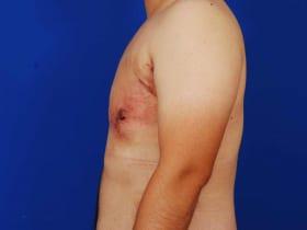 Gynecomastia Surgery Before & After Image